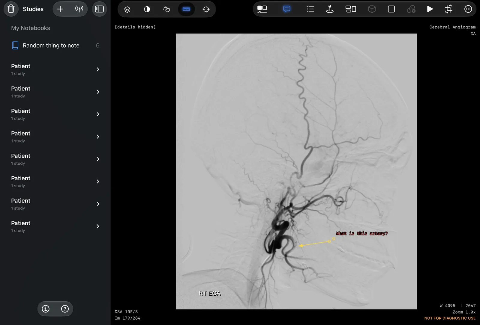 A cerebral angiogram with an arrow and the note: what is this artery?