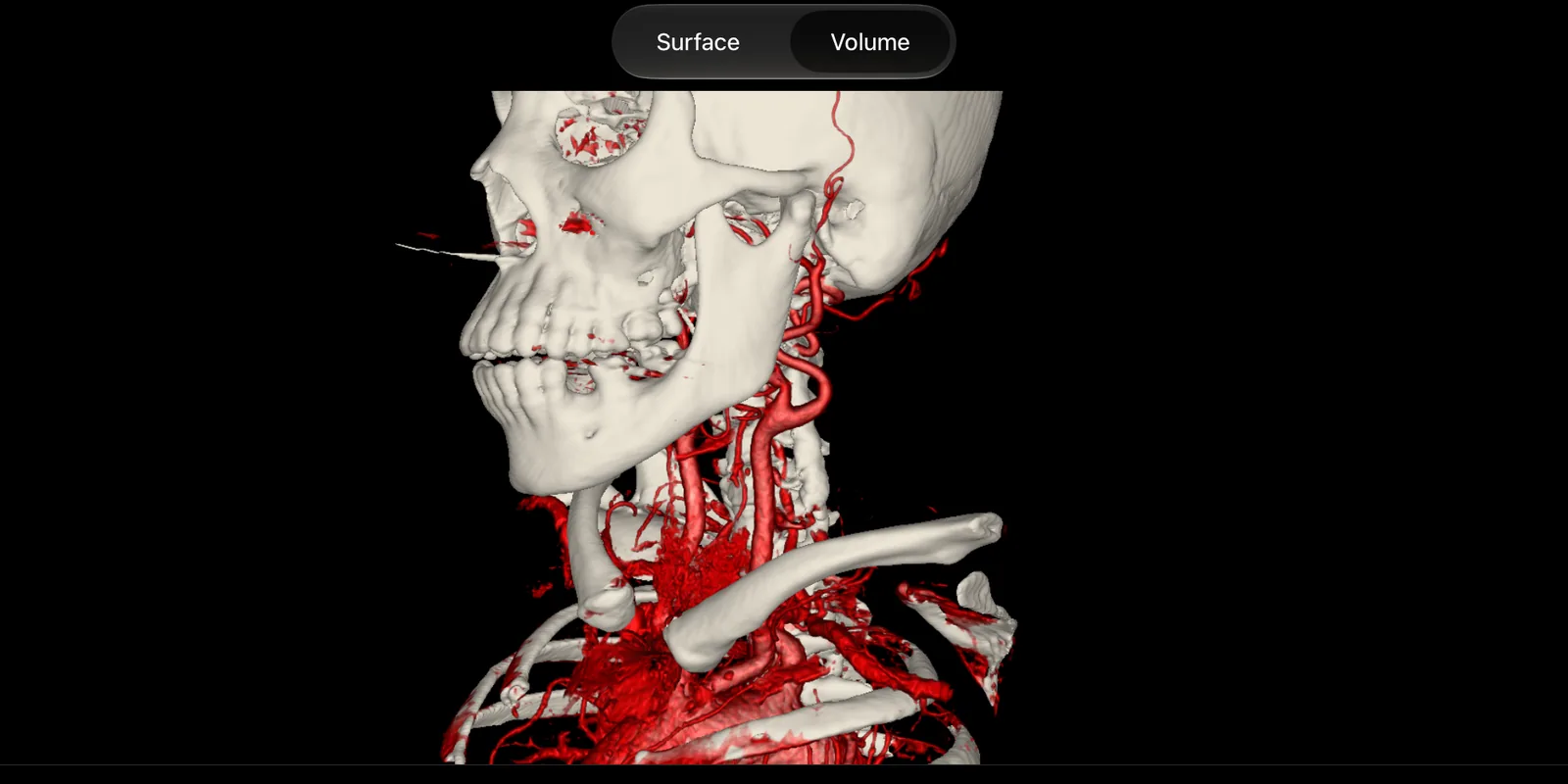 A volume render in voXel: the skull and neck vessels of a CT angiogram.