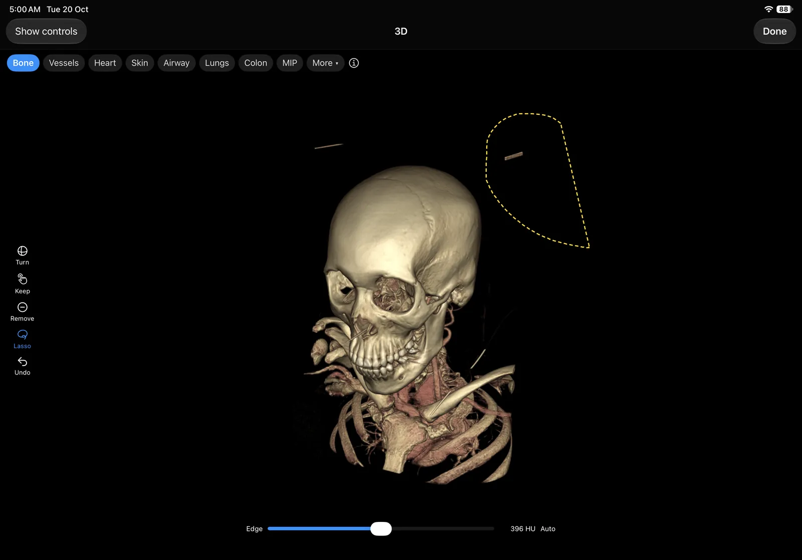 voXel on iPad: the 3D screen with a skull render and a lasso loop drawn beside it to cut a stray piece away.