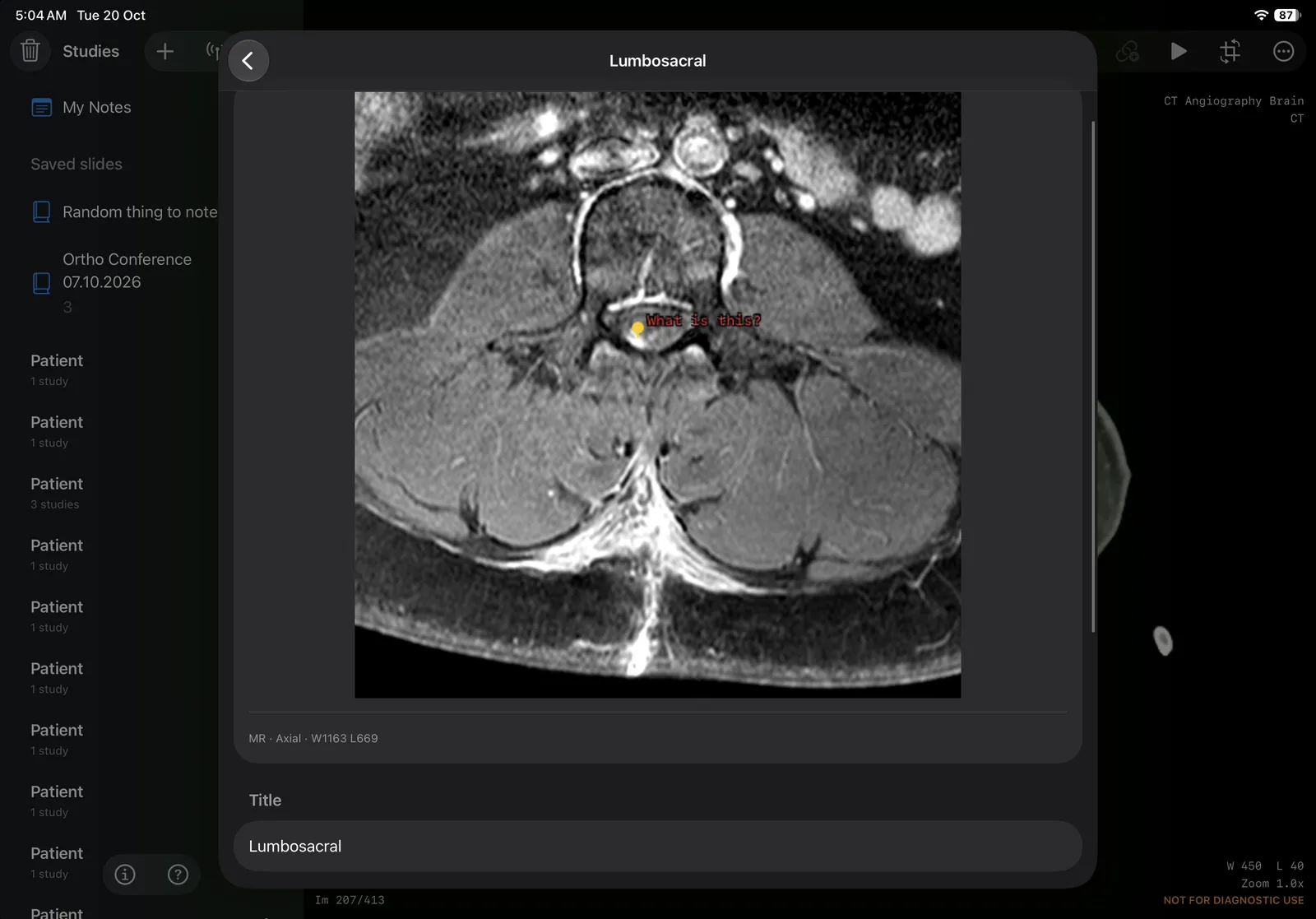 One saved slide: an axial MR slice of the lumbosacral spine with a marked finding.