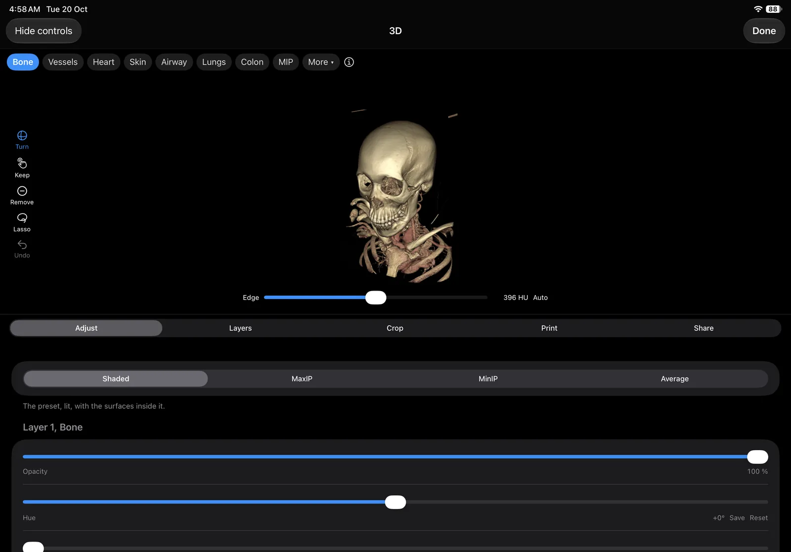 The 3D screen with Bone chosen from the presets along the top, a skull and neck vessels in the render, and the Adjust tab below.