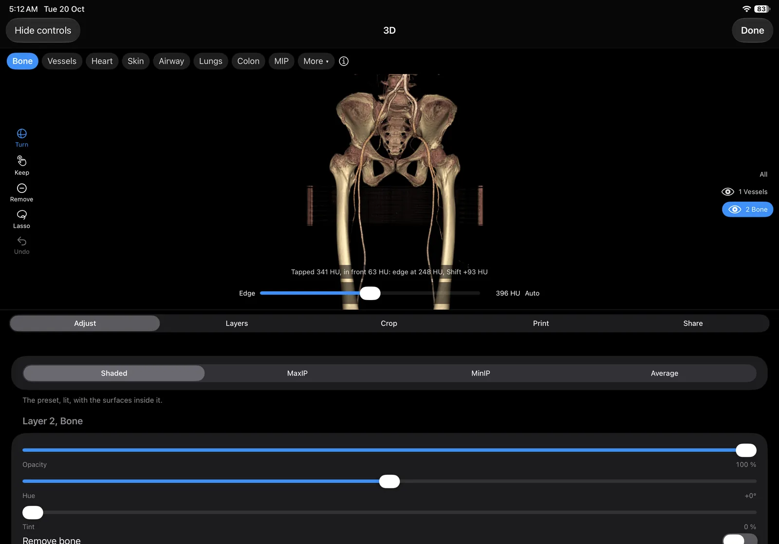 A pelvis and the leg arteries as two layers, Vessels and Bone, each with its own eye.